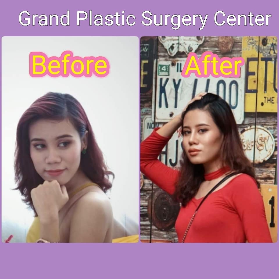 Grand Plastic Surgery Service Your Fitster Health And Beauty Myanmar